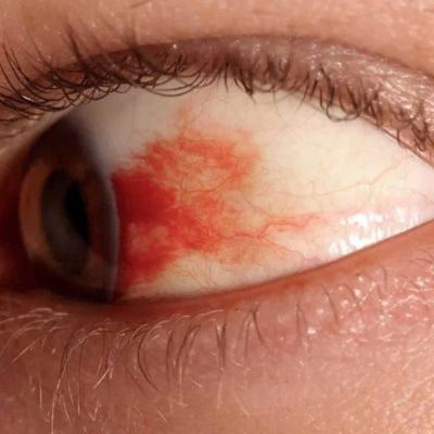 UNAM-desarrolla-gotas-oftalmicas-basadas-en-la-vasoinhibina-para-tratar-la-retinopatia-diabetica